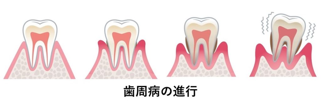 横浜　矯正歯科　歯周病の進行イラスト