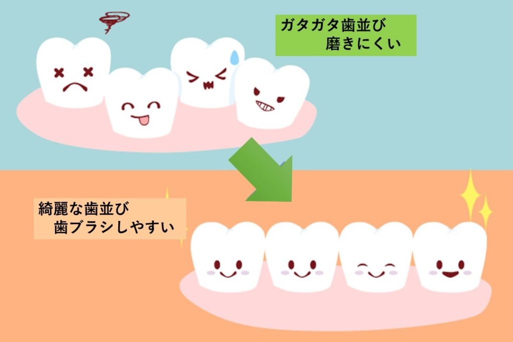 横浜　矯正歯科　歯並びと歯の保存性イラスト