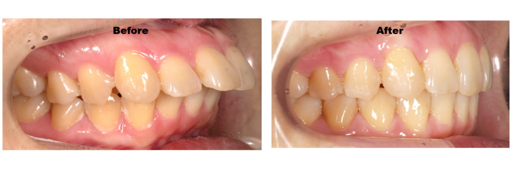 出っ歯、上顎前突の写真