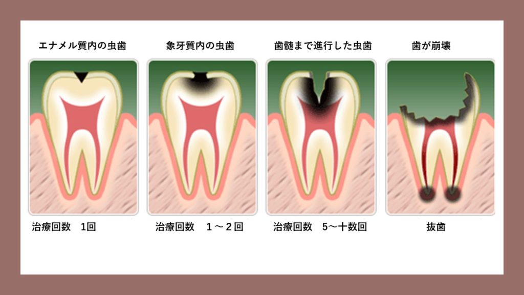 横浜の矯正歯科、ヨコハマデンタルオフィス、虫歯の進行