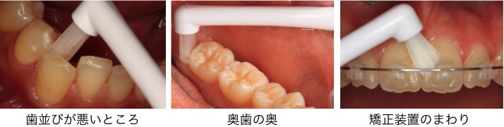 横浜マウスピース矯正歯科センターが考える正しい歯磨き　タフトブラシの使い方