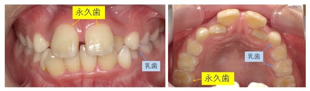 乳歯と永久歯列