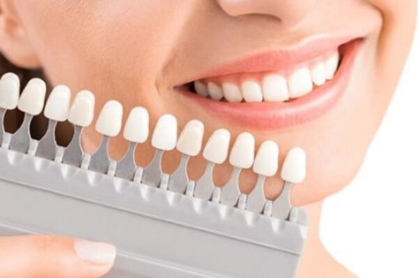 横浜の矯正歯科が解説。トランセントホワイトニングはどんな人におすすめ？