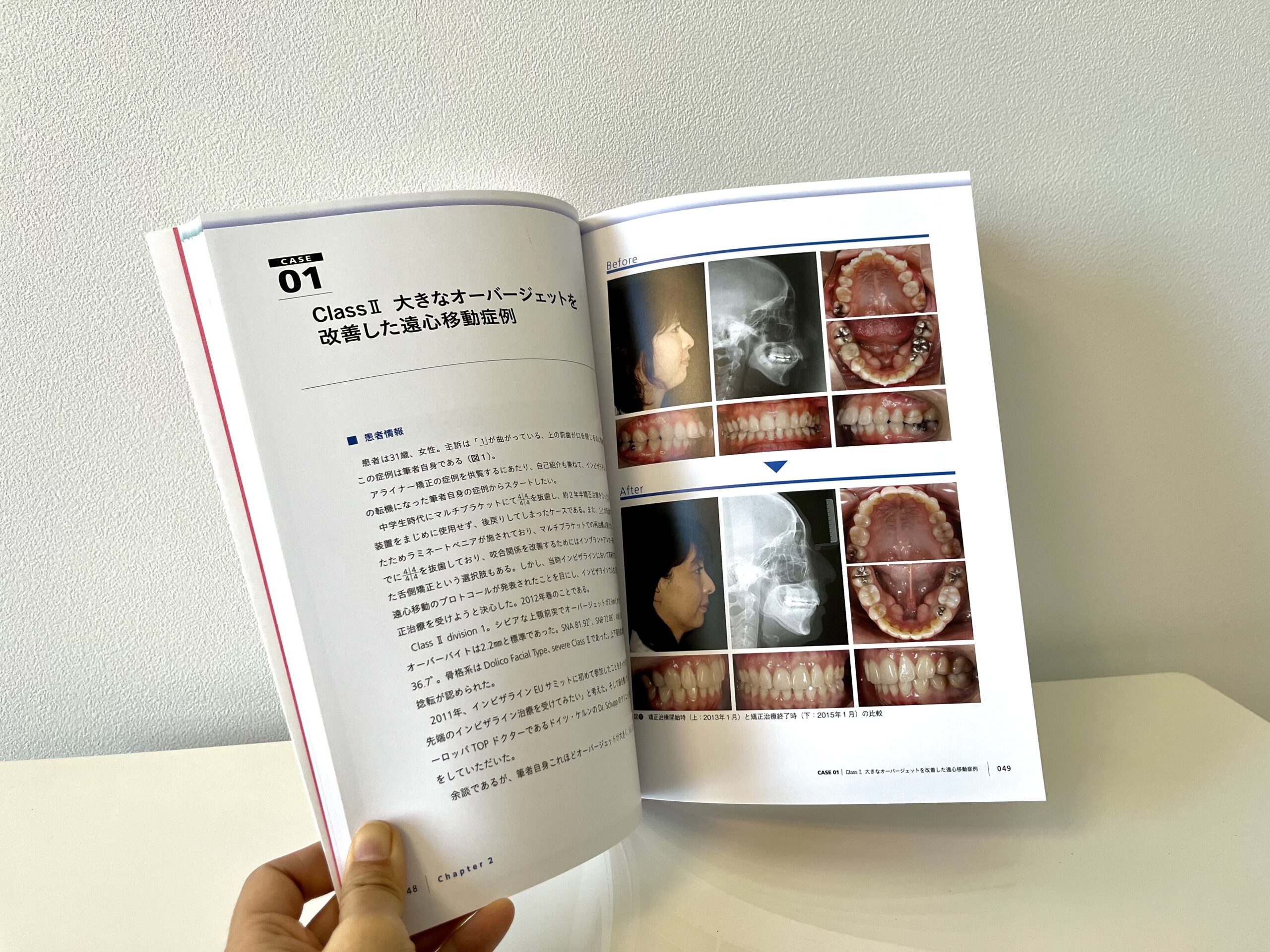 第1章では、アライナー矯正の診療をスムーズに進めるための基本手技を解説しています。治療開始からリテーナー装着までのチェアサイド業務をビジュアルで整理し、実際の手技動画とあわせて学ぶことができます。